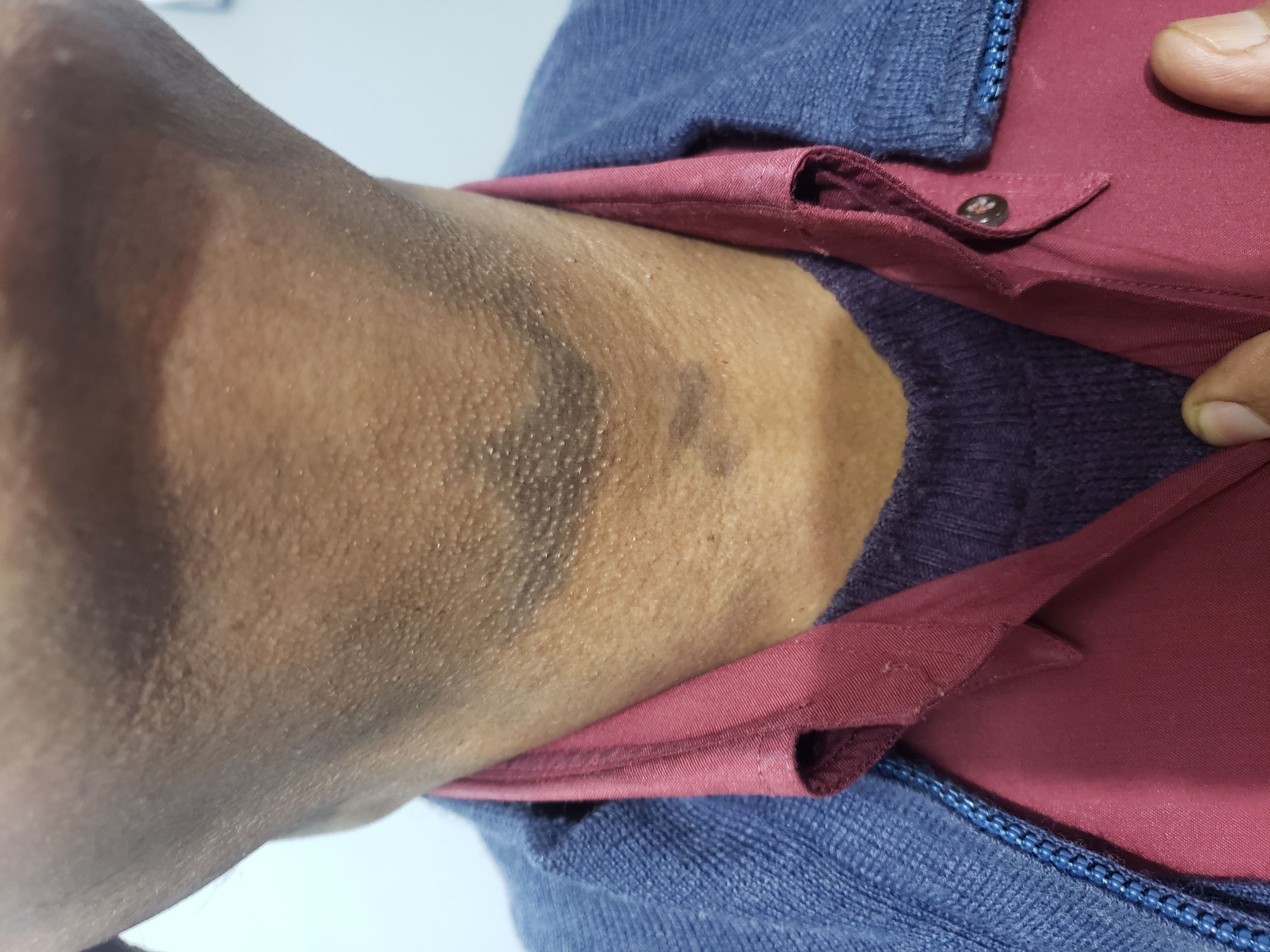 Is This A Acanthosis Nigricans Or Aging Marks?