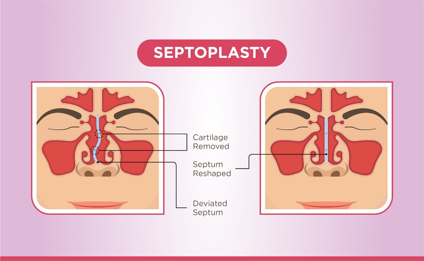 Septoplasty – An Effective Surgical Option For Nasal Congestion In Patients With Deviated Septum