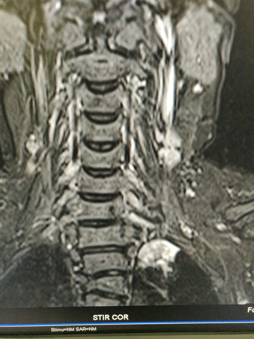 Thyroid Lesions