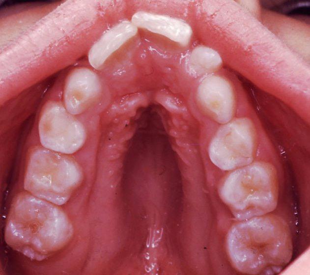 Causes Of High Arched Palate