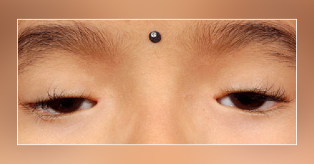 Blepharophimosis Syndrome