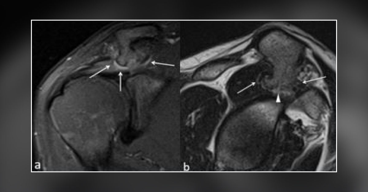 Diagnose the Case of Severe Shoulder Pain