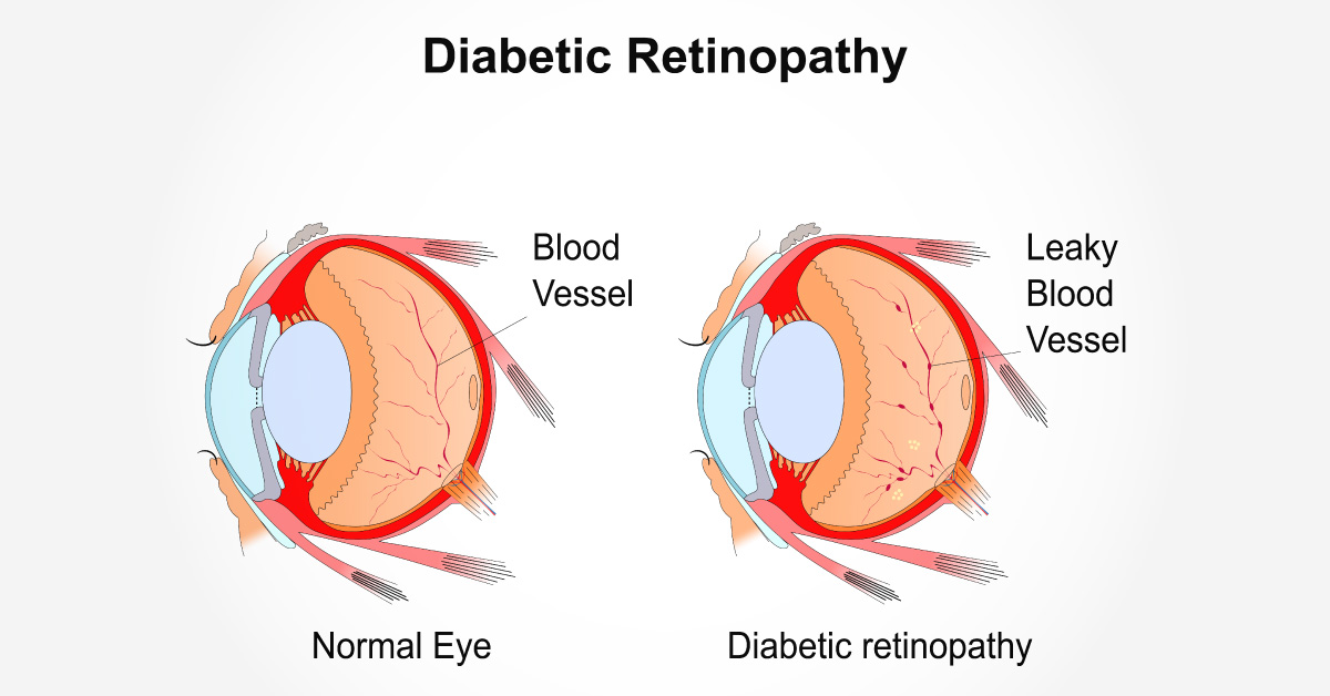 Scenario Of Haemorrhages In Diabetic Retinopathy