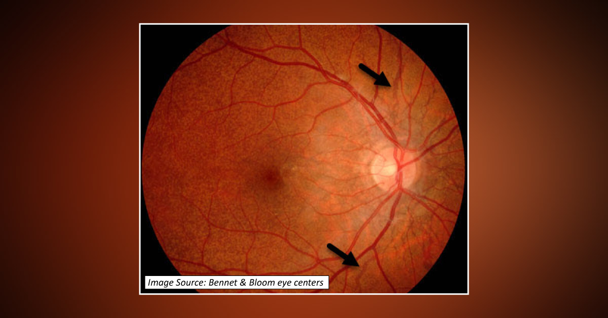 Causes Of Angioid Streaks