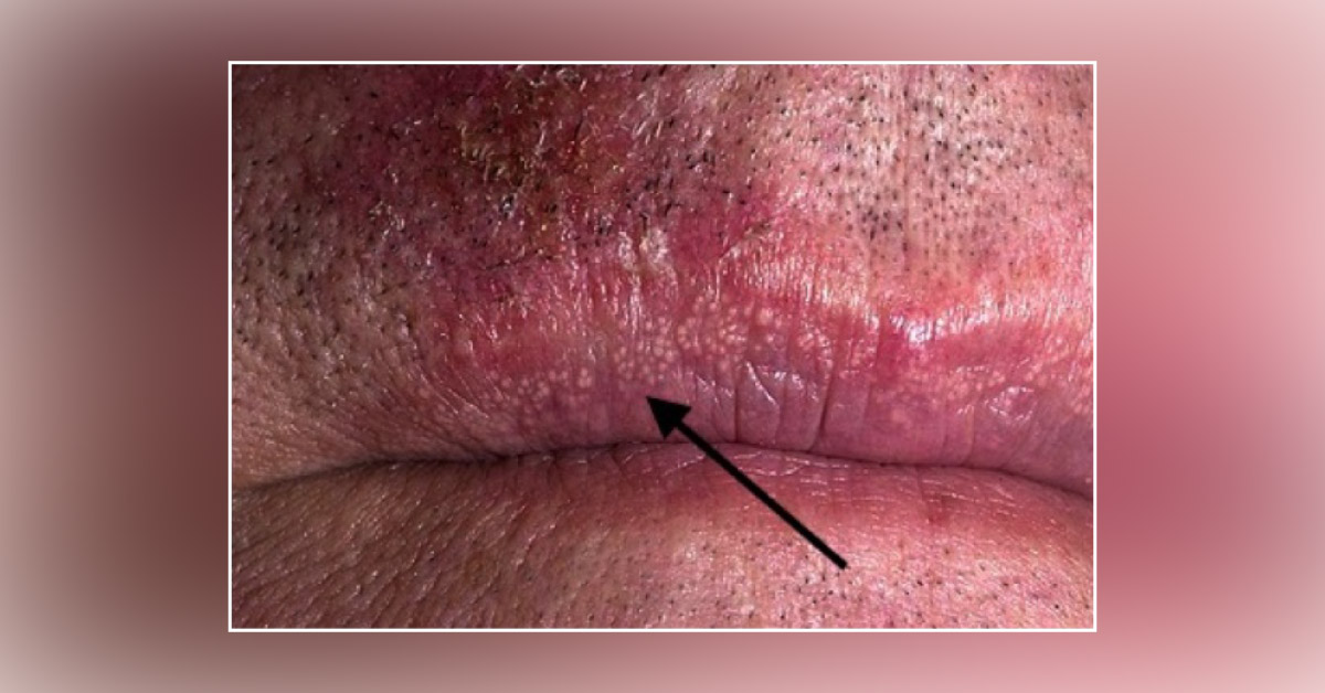 Identify This Upper Lip Lesion