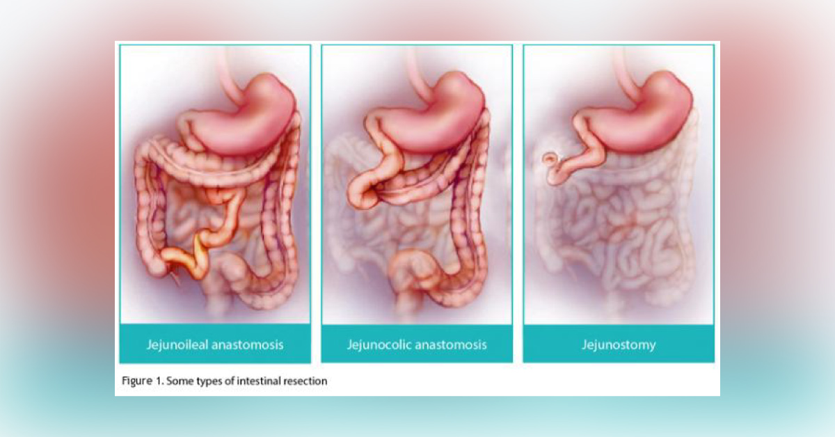 Glepaglutide  Improves Intestinal Absorption In Patients With Short Bowel Syndrome: Phase 2 Trial