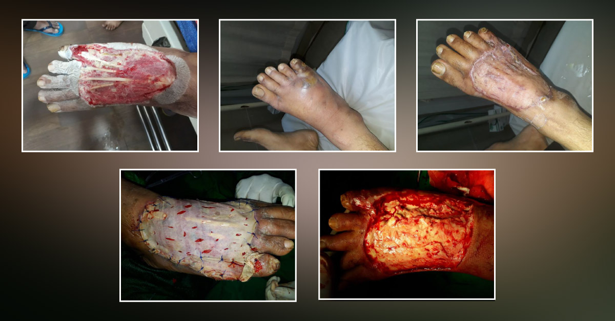 Diabetic Foot infections