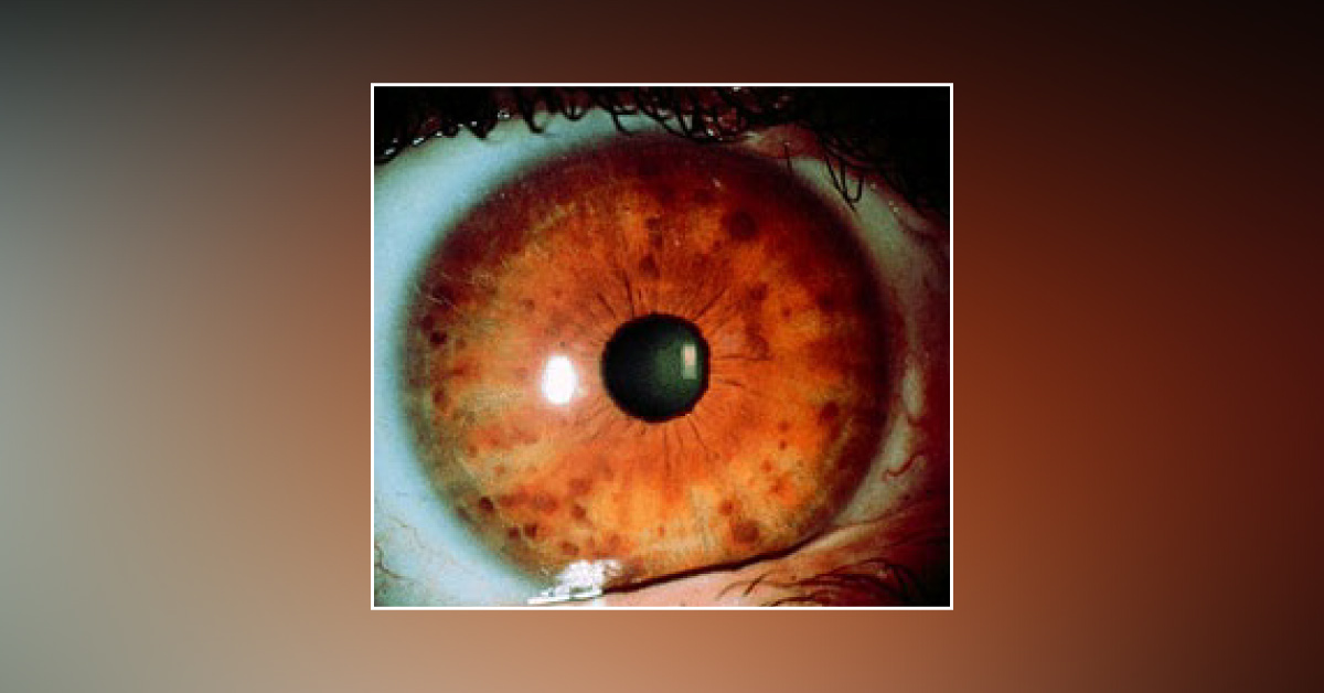 Brief post on some of the ocular manifestations of neurofibromatosis