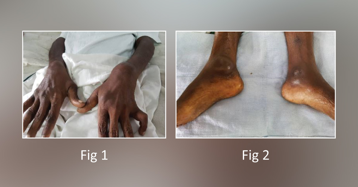 Case of a Man with Deformity in His Knees, Ankles, and Wrist Joint