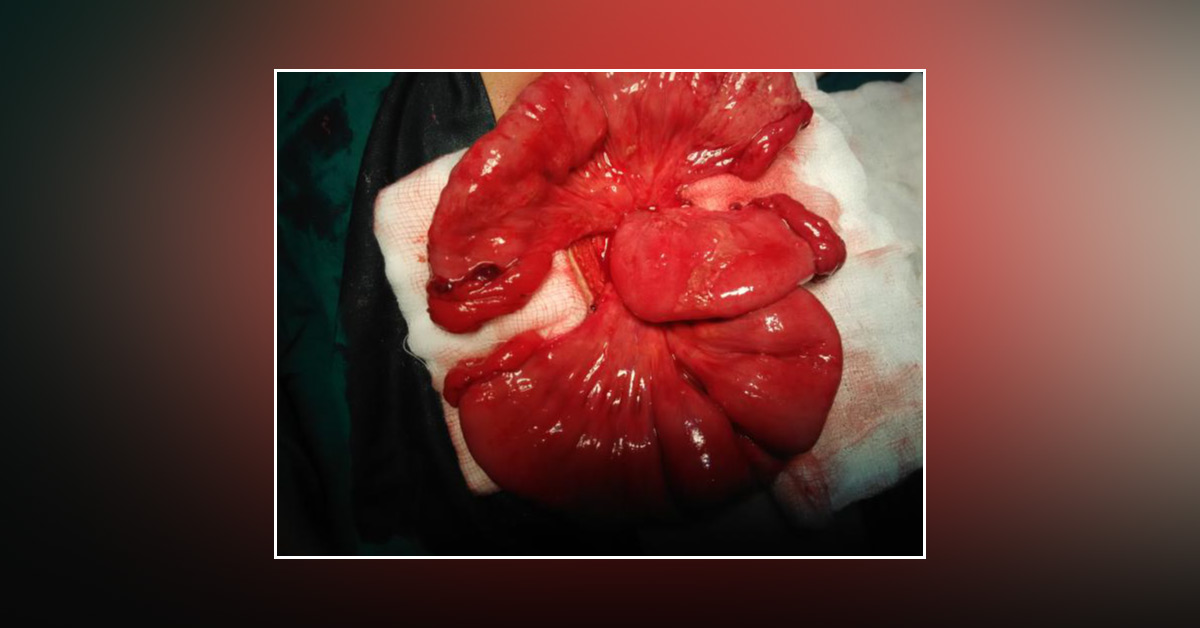 Case Of Double Jejunal Laceration