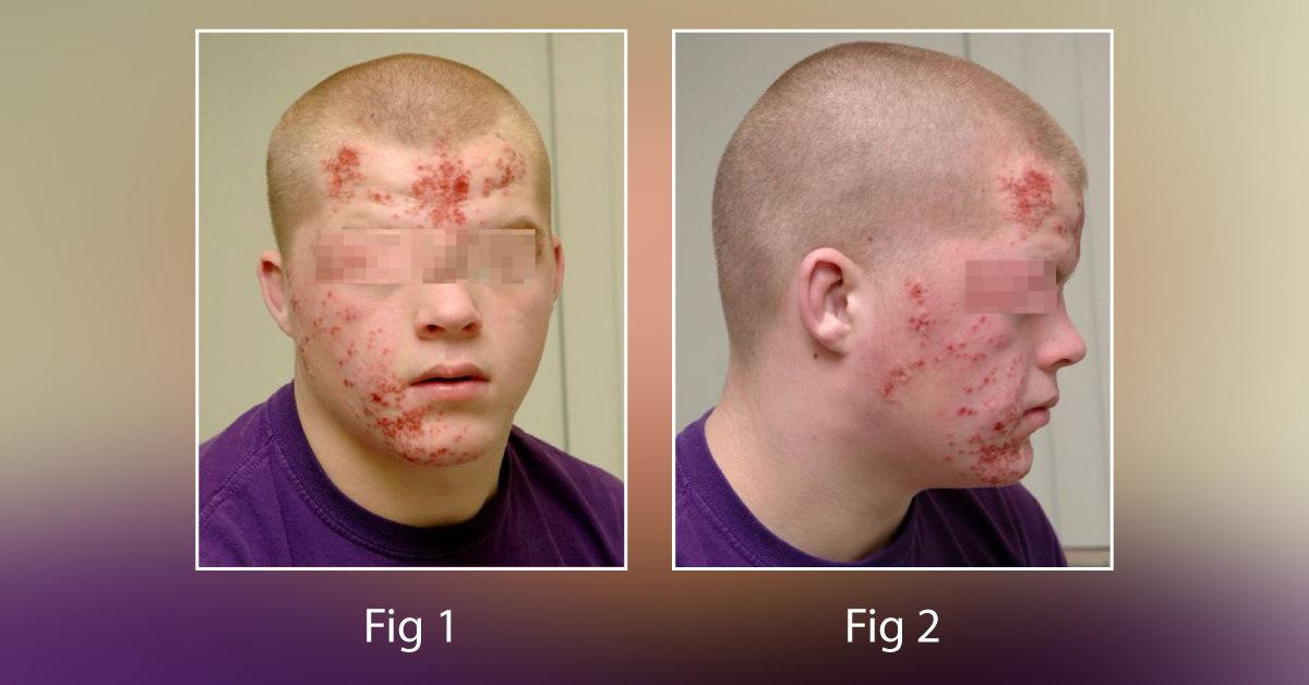 A Baffling Case Of Facial Rash On A 17-Year-Old Boy