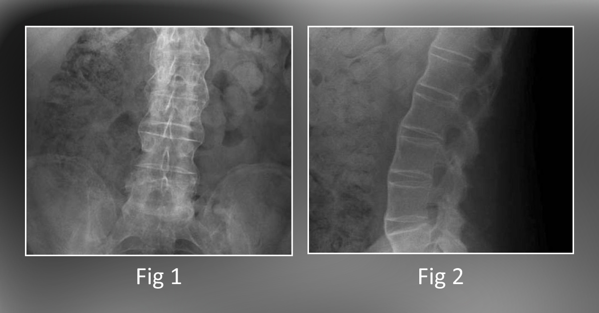 A Young Male With Back Pain and Stiffness