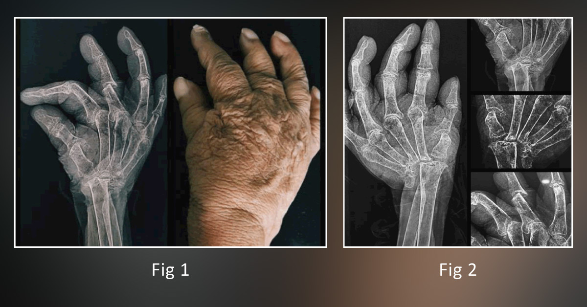 An Unusual Case Of Psoriatic Arthritis Mutilans