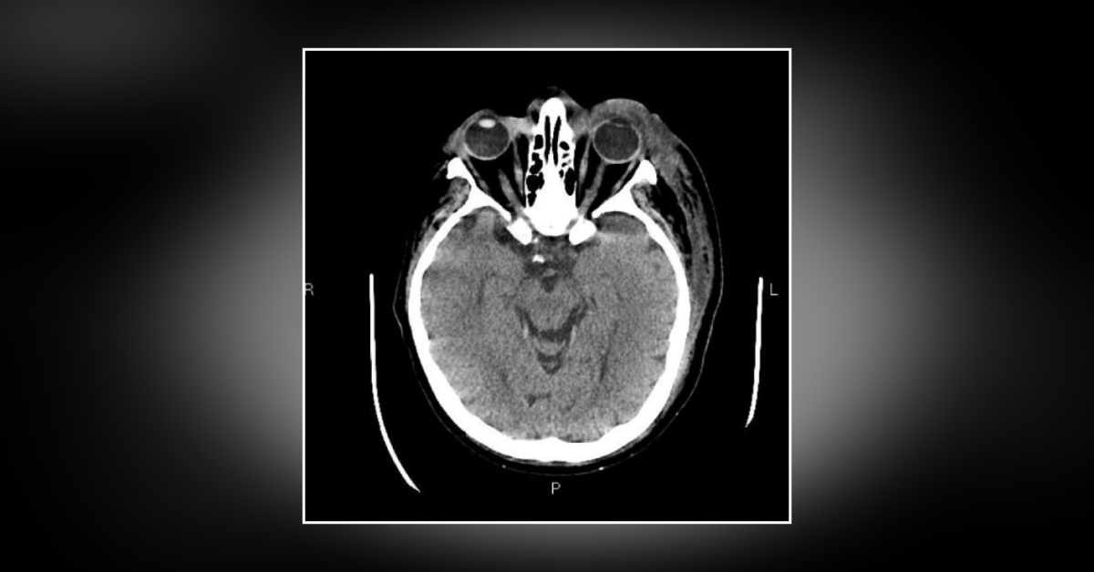 Case of a Geriatric Patient with Recurrent Episodes of Herpetic Keratitis