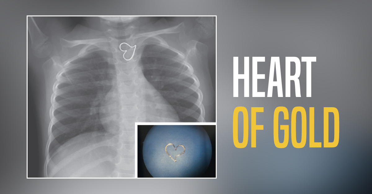 A 3-year-old girl Presenting to the ED with an Ingested Pendant