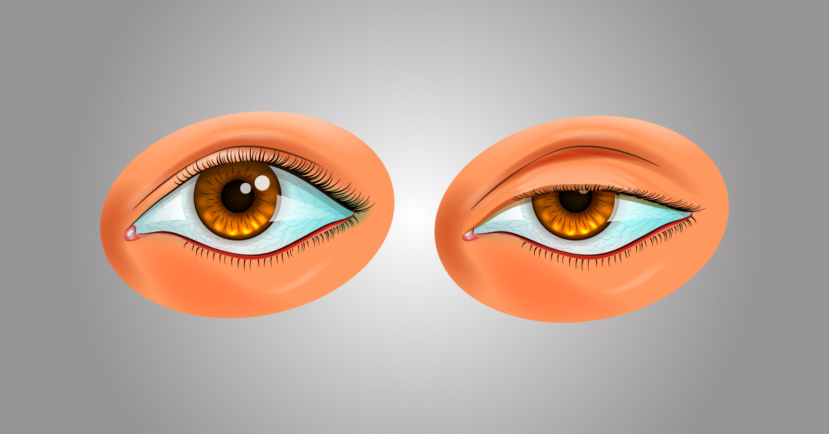 Classification Of Ptosis