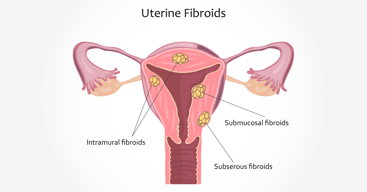 New Uterine Fibroids Oral Treatment Could Replace Surgery