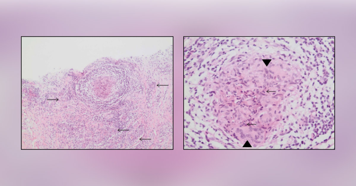 An Intriguing Case of a Breast Pseudotumor