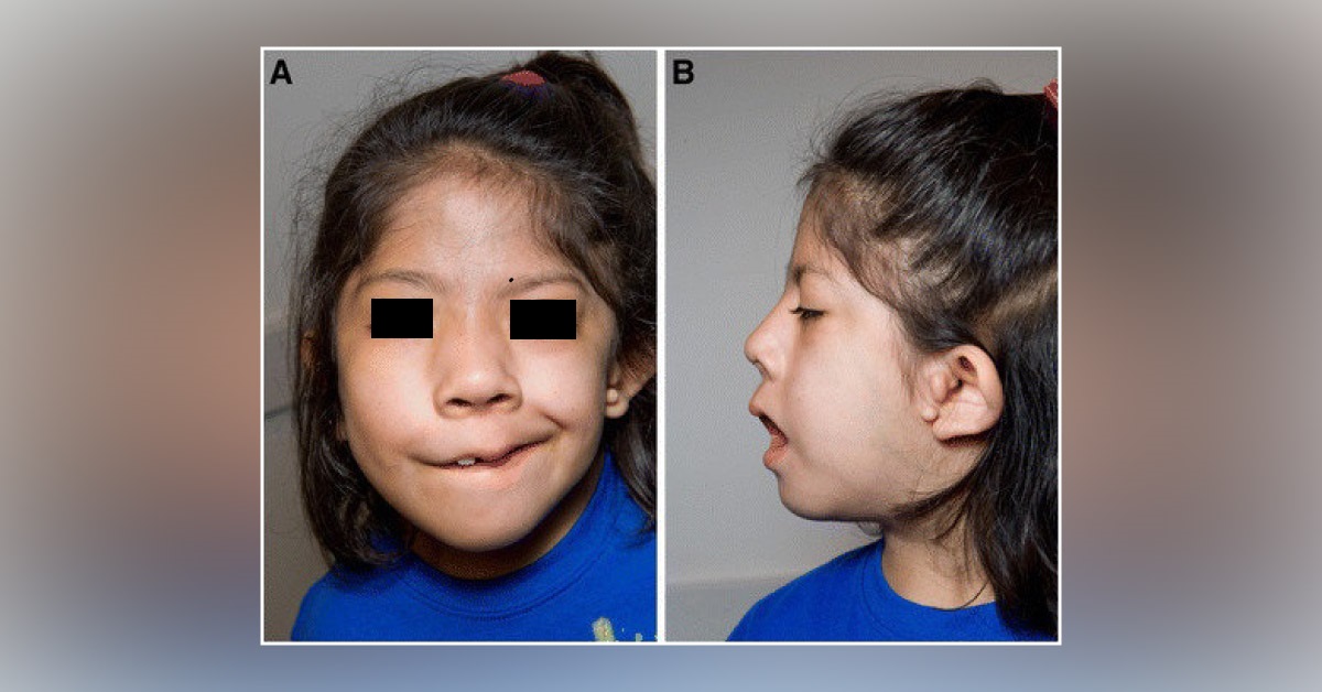 Problems Associated Of Goldenhar syndrome