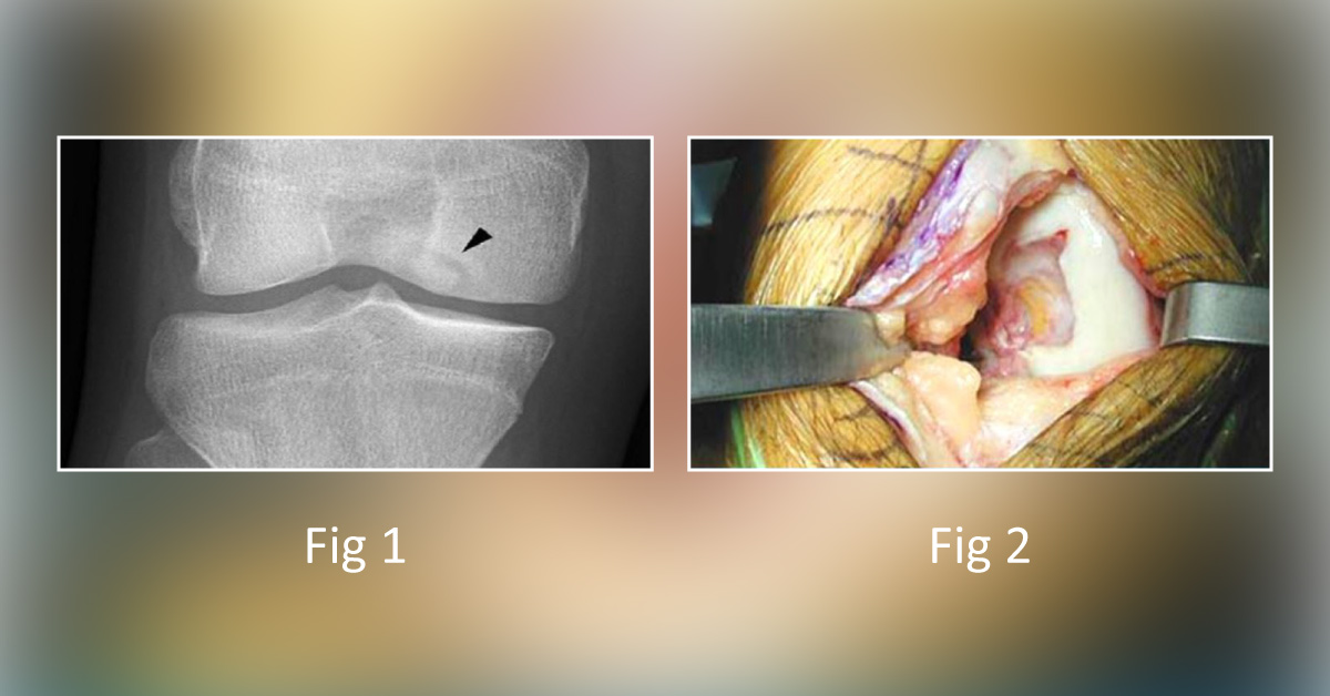 " Save My Knee!" - What's Your Diagnosis for This Soccer Player?