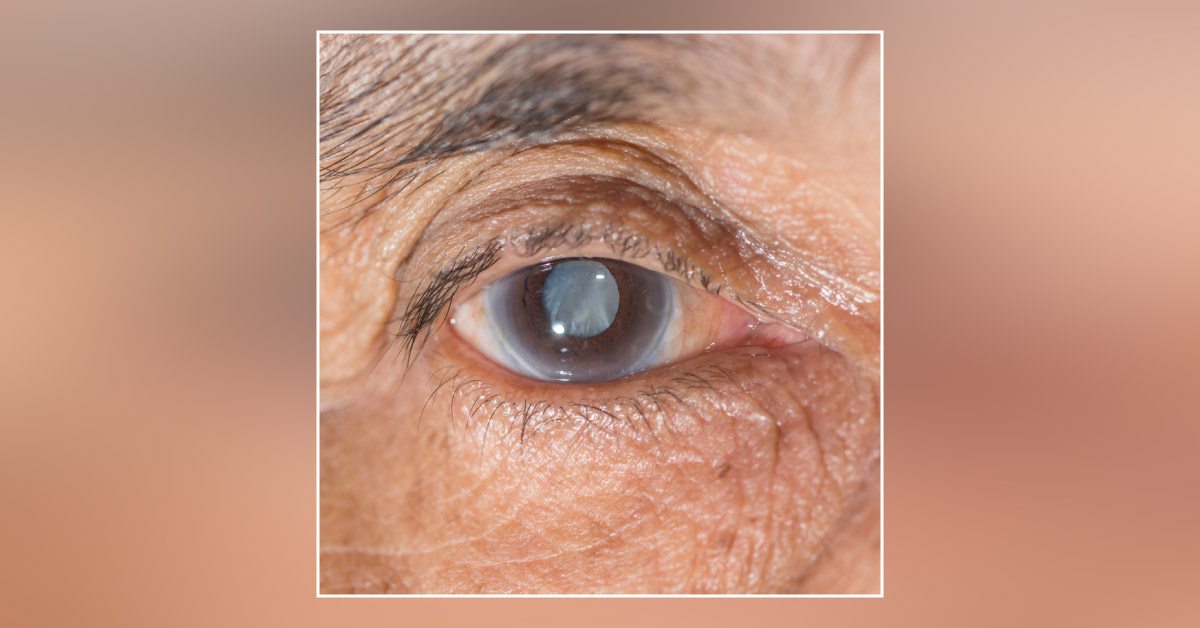 Brief Review On Ocular Manifestations