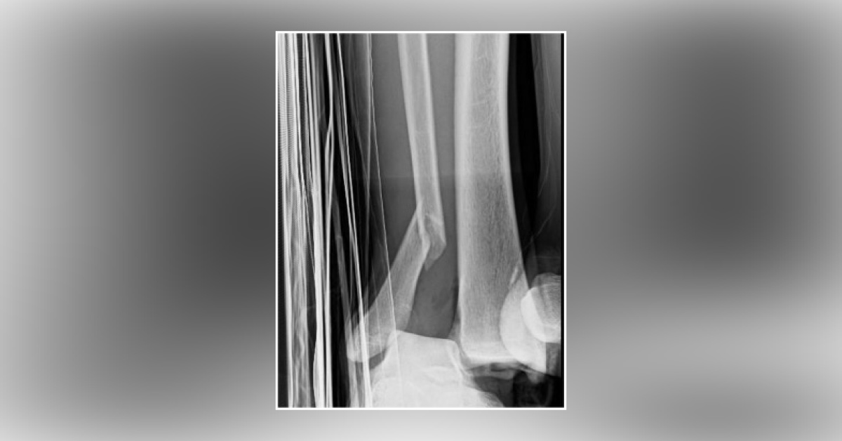 Diagnose This Unusual Fracture