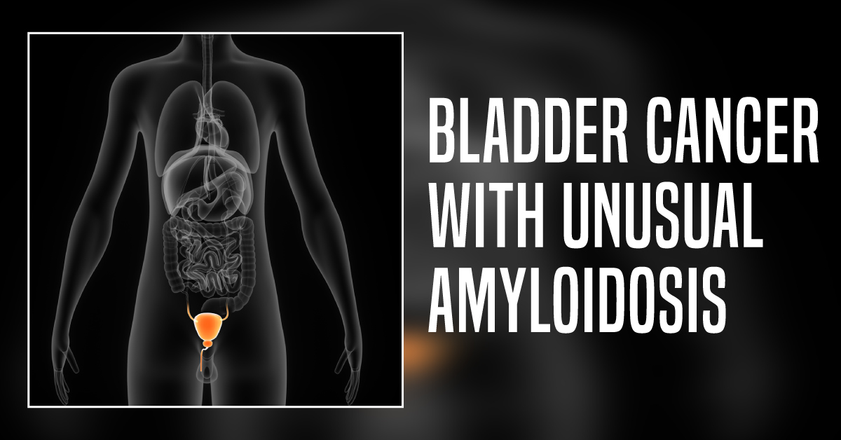 Novel Diagnosis - Amyloidosis Without Dialysis in Bladder Cancer