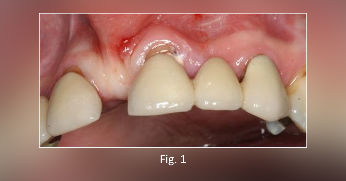 Case of a Woman with Toothache for the Past Two Years and a Medical History of Asthma