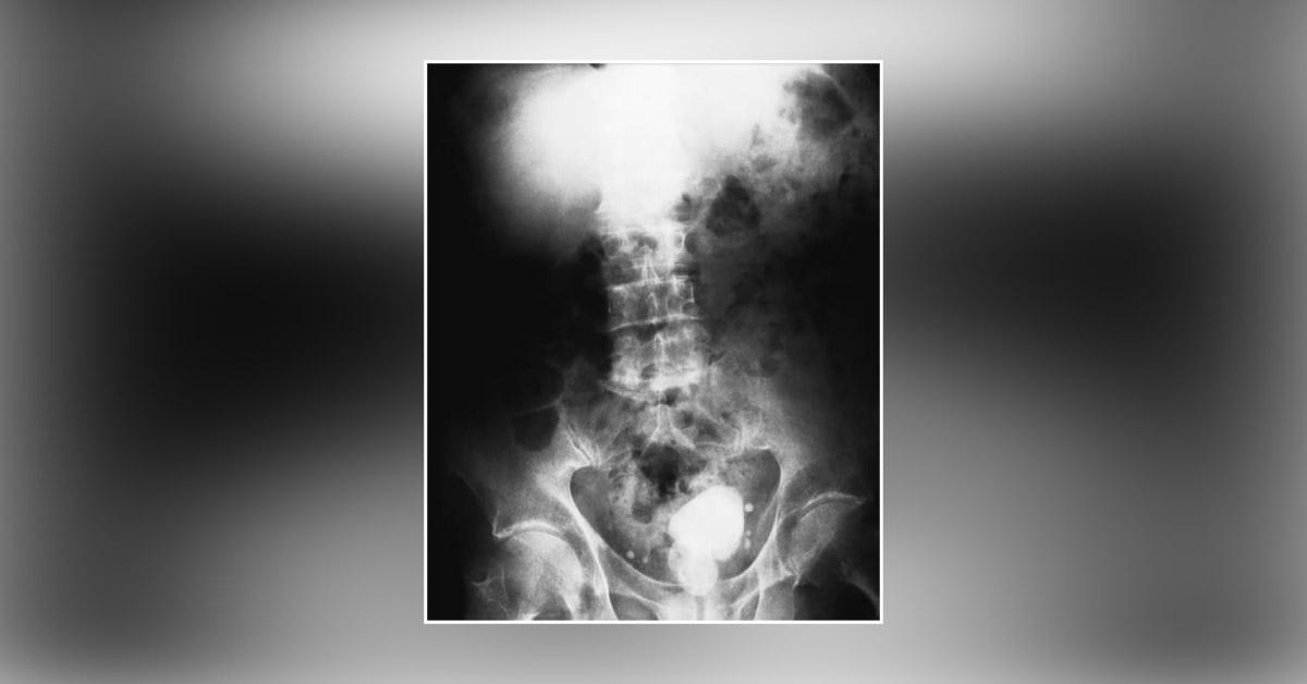 An Elderly Man with Difficulty in Micturition: Diagnose His Condition