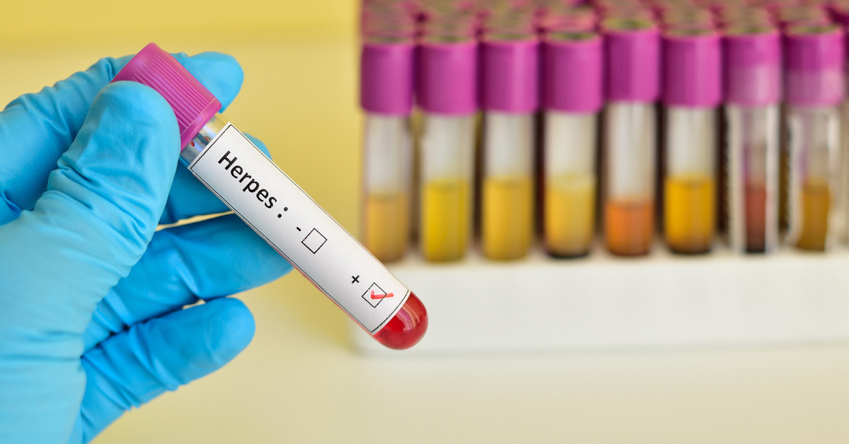 Space Travel Can Trigger Dormant Herpes Viruses: NASA