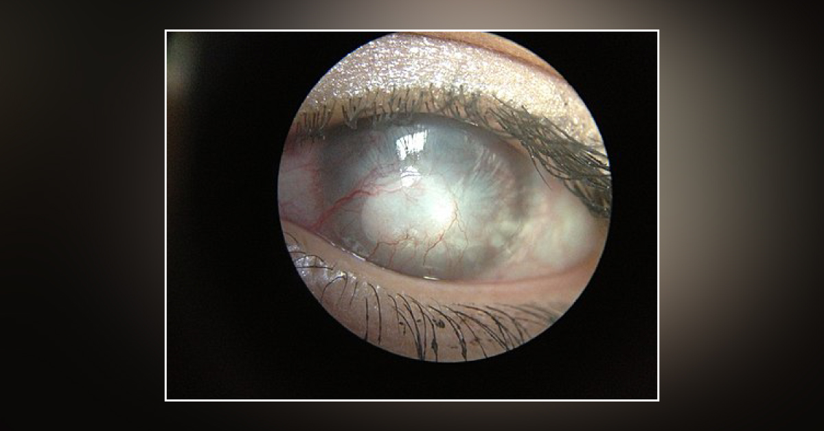 Causes Of Corneal Neovascularisation