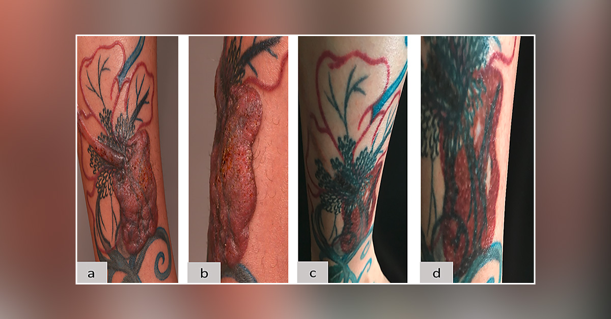 Case of a Woman with a Rare Reaction to Red Tattoo Pigment