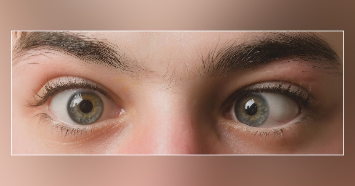 Different Presentations Of Paralytic Squint