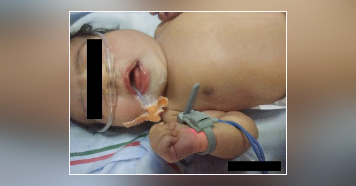 Frothing From Mouth Of Neonate