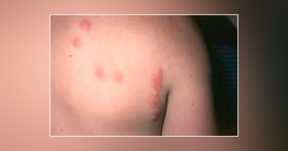 Suggest Medication for This Patient Taking Propranolol Every Day for Hereditary Tumors