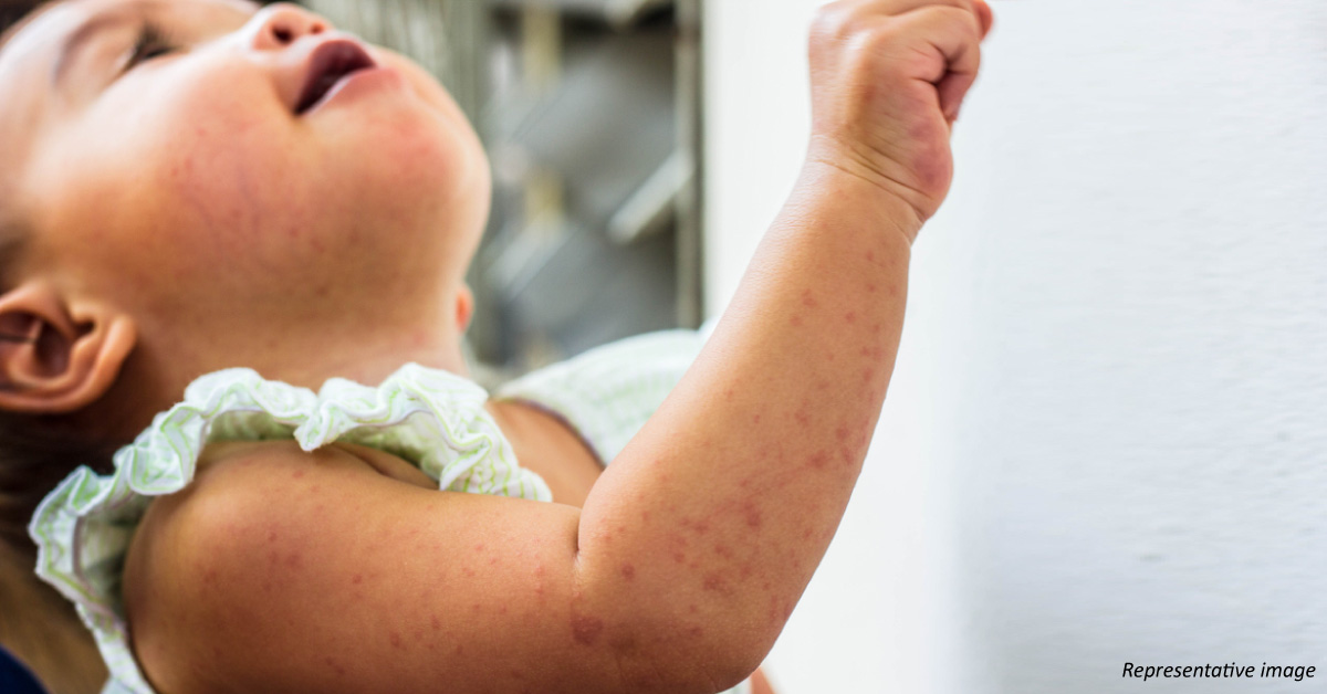 Case of a Child with Maculopapular Erythematous Rashes