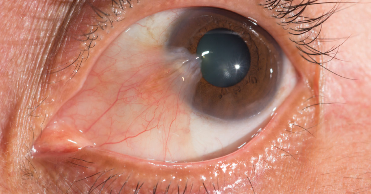 Rare Severe Complications Of Pterygium Surgery