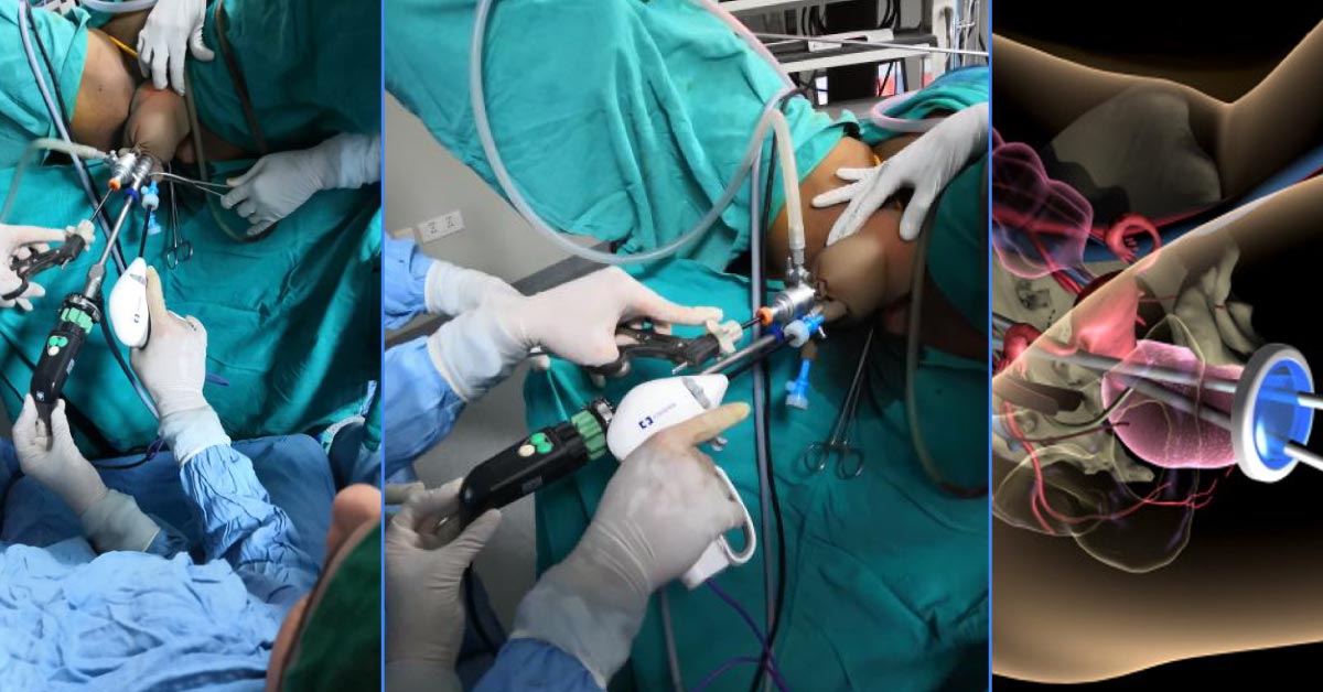 Beginning Of Transvaginal NOTES (Scarless) Gynecological Surgery In India