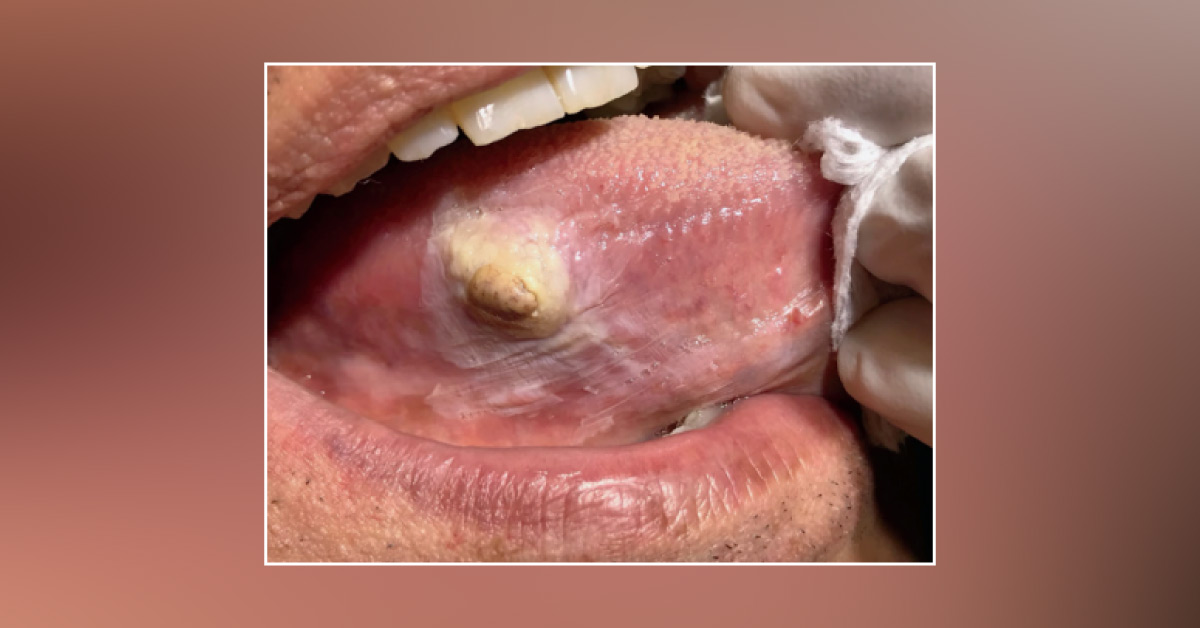 Case of a Man with a Brown Lesion on the Tongue