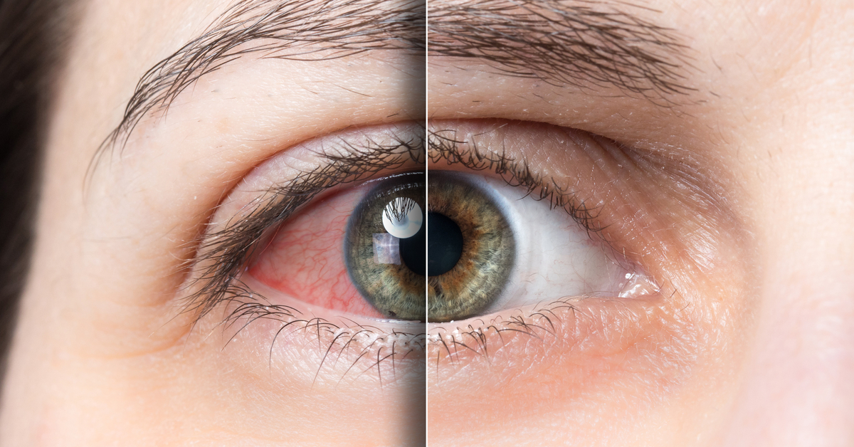 Ocular Side Effects Of Prostaglandin Analogues