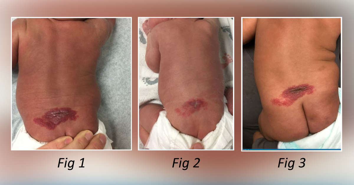 A Neonate with a Dermal Lesion