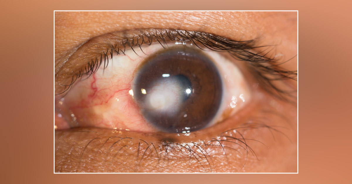 Causes Of Corneal Vascularisation