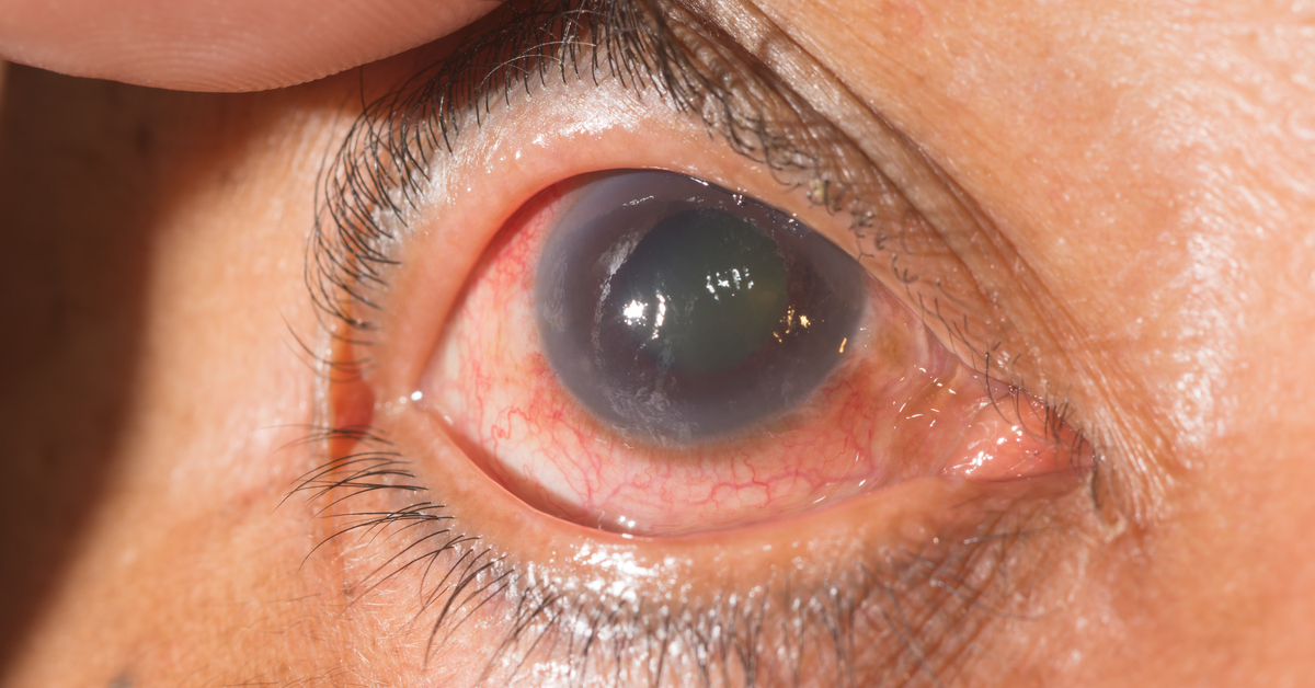 Classification Of Glaucoma