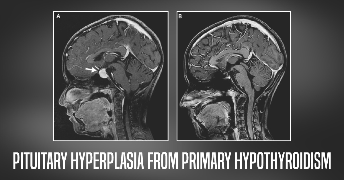 Unusual Manifestation Of Pituitary Hyperplasia From Primary Hypothyroidism