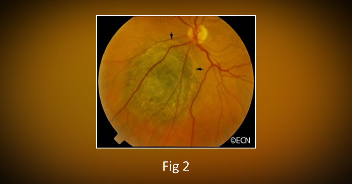 Diagnostic Modalities Of Choroidal Melanoma