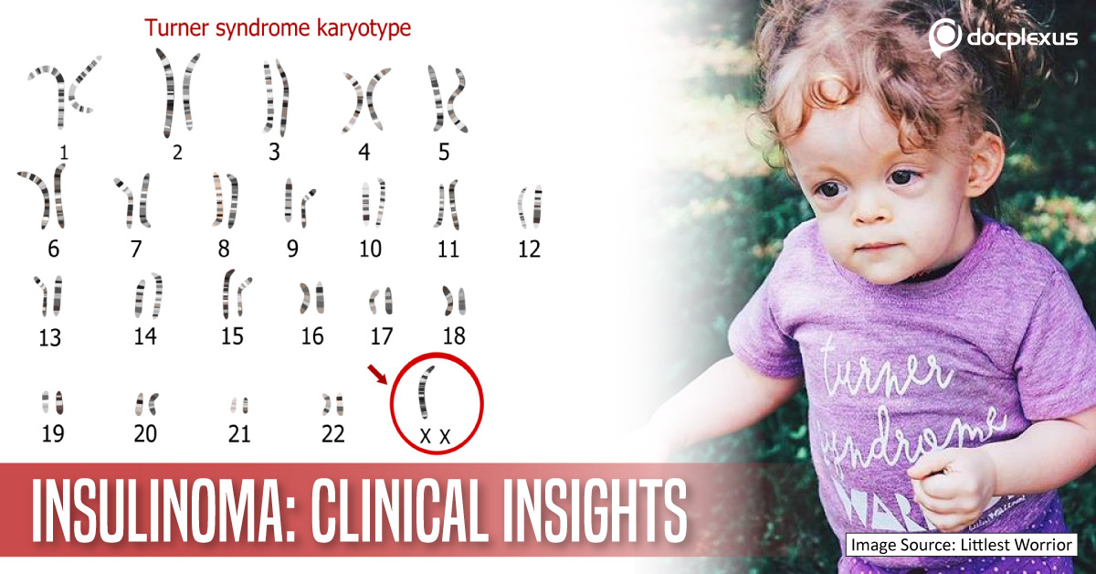 Biochemical And Clinical Features Of Insulinoma In Turner Syndrome