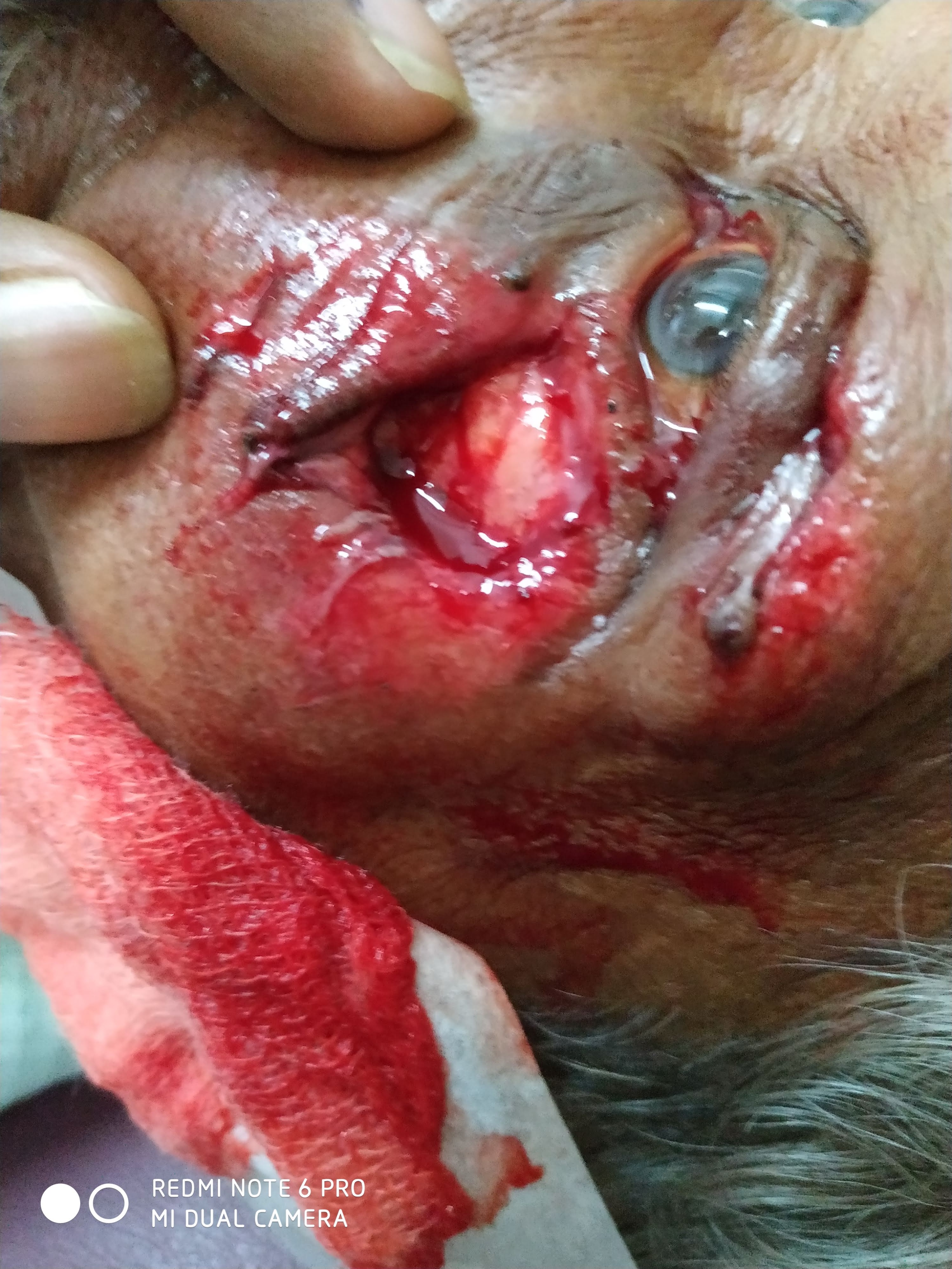 Case Of Post Traumatic Ectropion