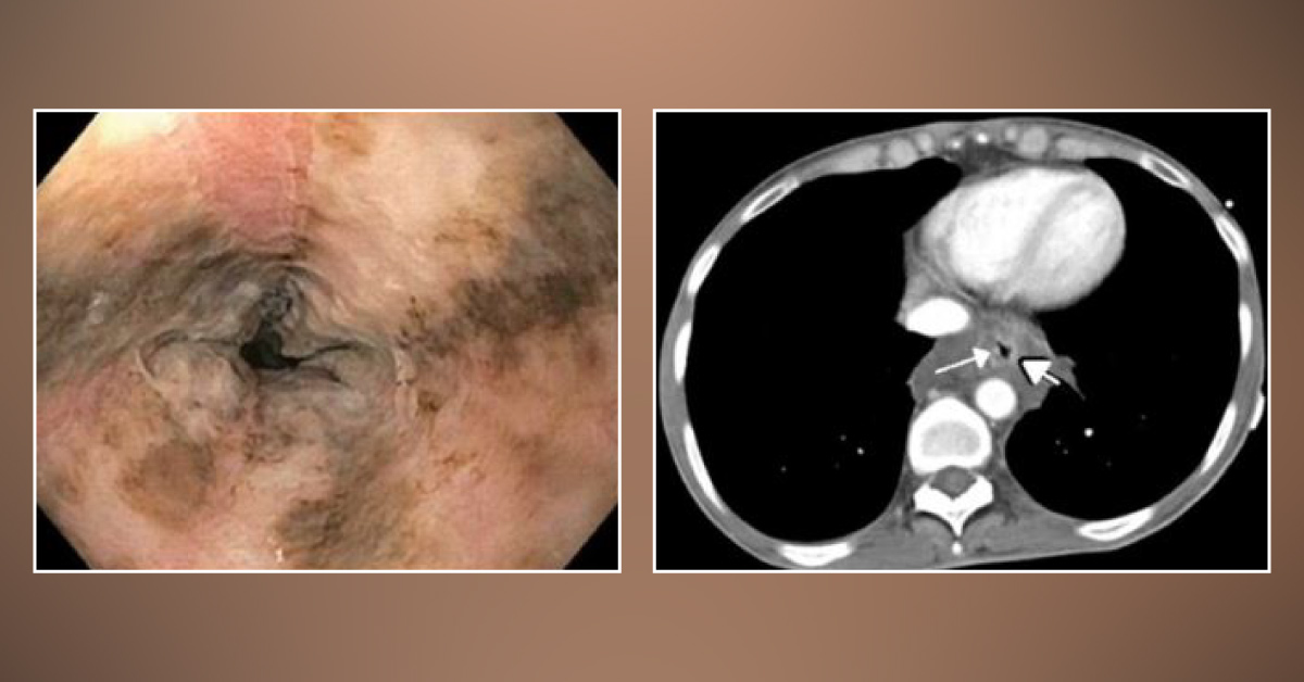 What is Causing a Black Esophagus?