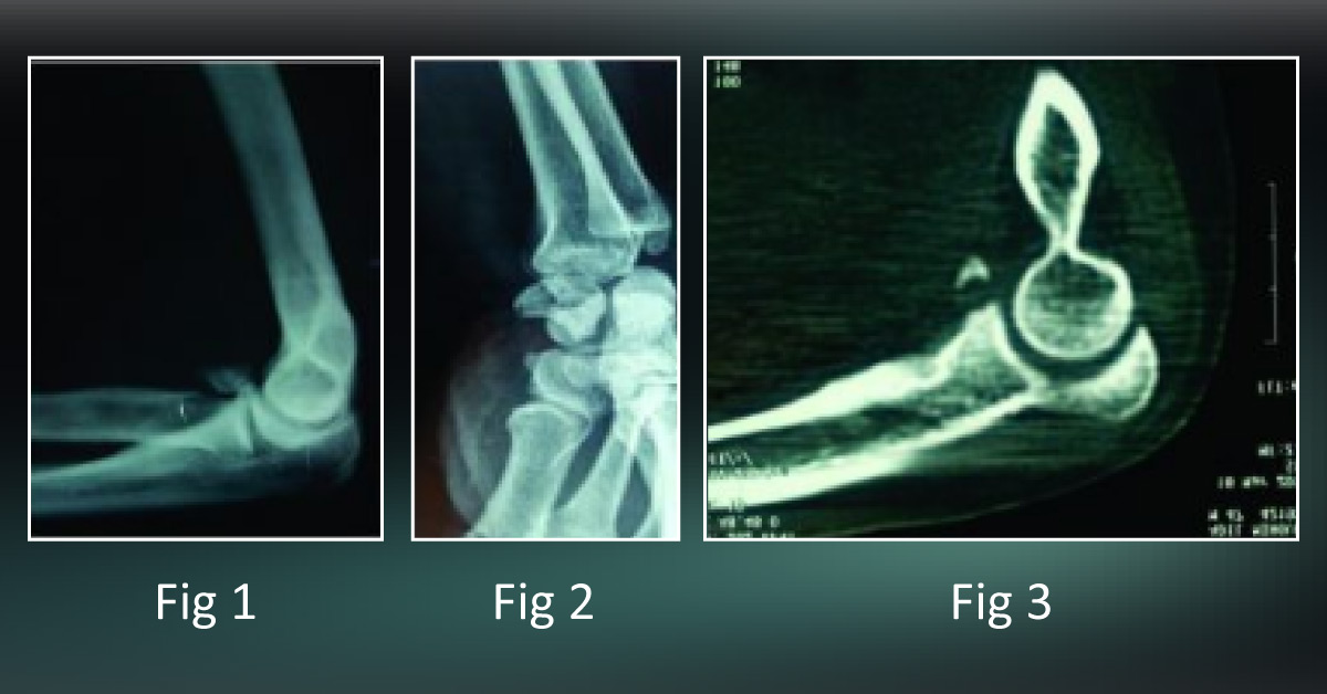 Help! My Forearm Has Shortened