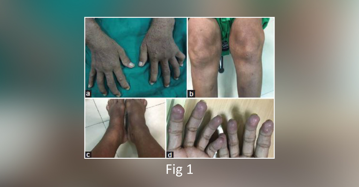 Unusual Presentation of an Uncommon Disease – What’s Your Diagnosis?